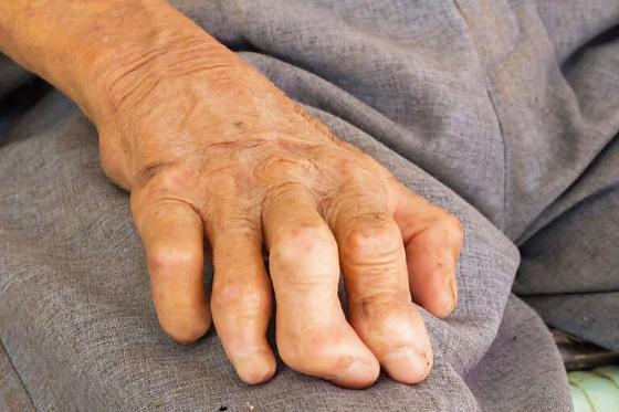 Levantamento revela dados preocupantes da doença